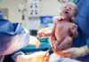 роды, анестезия, новорожденный
